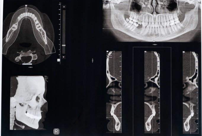 симптомы дисфункции височно-нижнечелюстного сустава